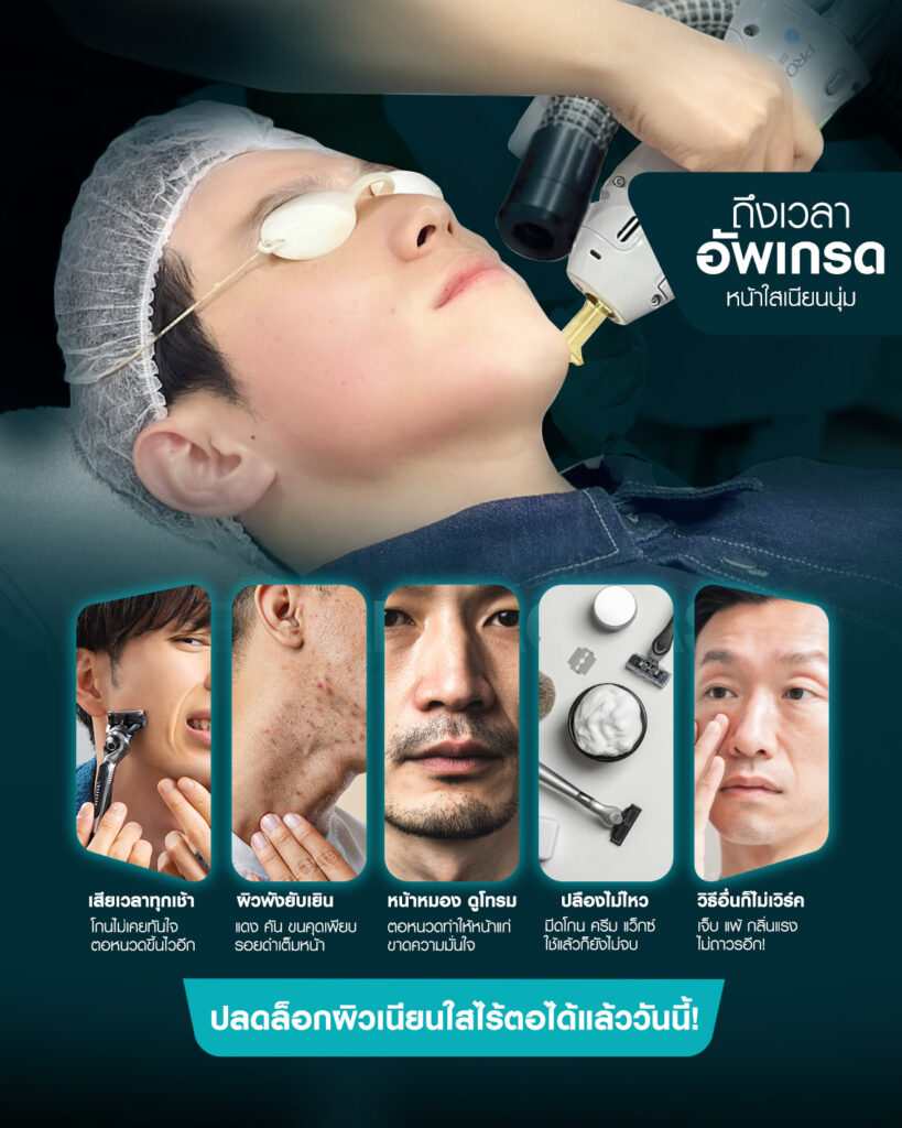 beard-laser-removal