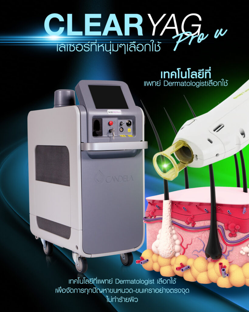 clear-yag-pro-u-hair-removal-laser