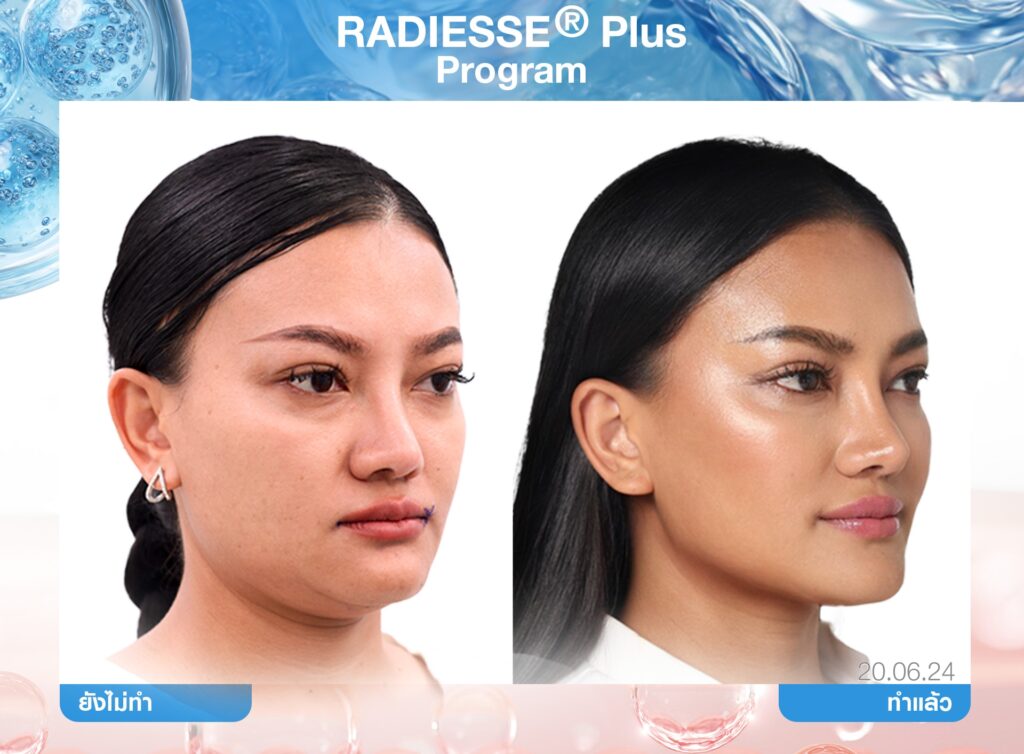 Biostimulator, สารกระตุ้นคอลลาเจน, คอลลาเจน, ผิวชุ่มชื้น, เกราะป้องกันผิว, หน้าเด็ก, หน้าแก่ก่อนวัย