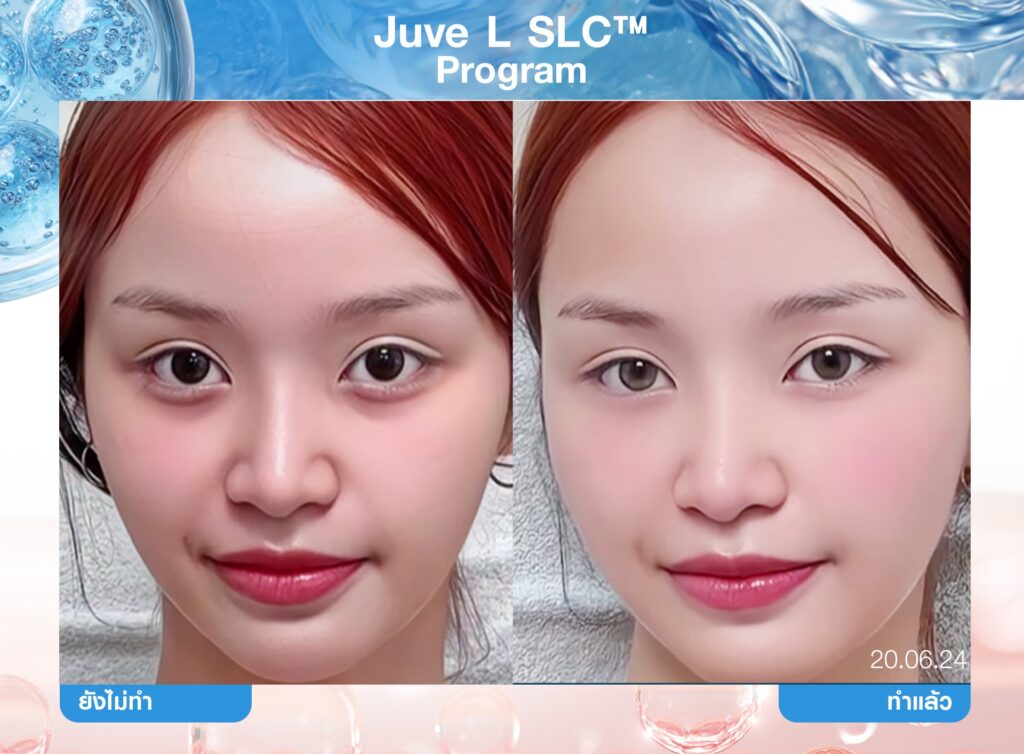Biostimulator, สารกระตุ้นคอลลาเจน, คอลลาเจน, ผิวชุ่มชื้น, เกราะป้องกันผิว, หน้าเด็ก, หน้าแก่ก่อนวัย