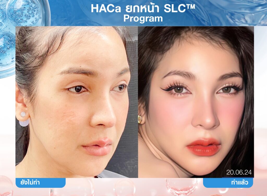 Biostimulator, สารกระตุ้นคอลลาเจน, คอลลาเจน, ผิวชุ่มชื้น, เกราะป้องกันผิว, หน้าเด็ก, หน้าแก่ก่อนวัย