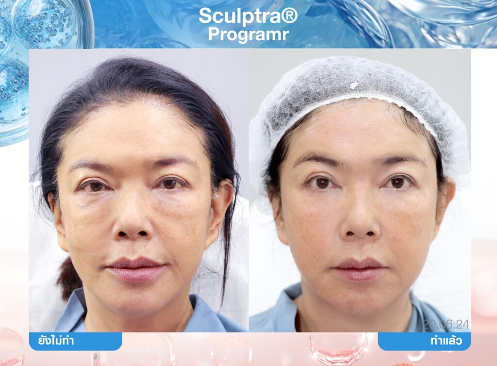 Biostimulator, สารกระตุ้นคอลลาเจน, คอลลาเจน, ผิวชุ่มชื้น, เกราะป้องกันผิว, หน้าเด็ก, หน้าแก่ก่อนวัย
