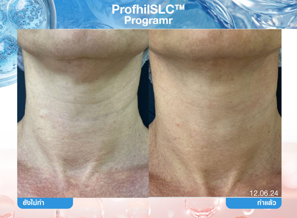 Biostimulator, สารกระตุ้นคอลลาเจน, คอลลาเจน, ผิวชุ่มชื้น, เกราะป้องกันผิว, หน้าเด็ก, หน้าแก่ก่อนวัย
