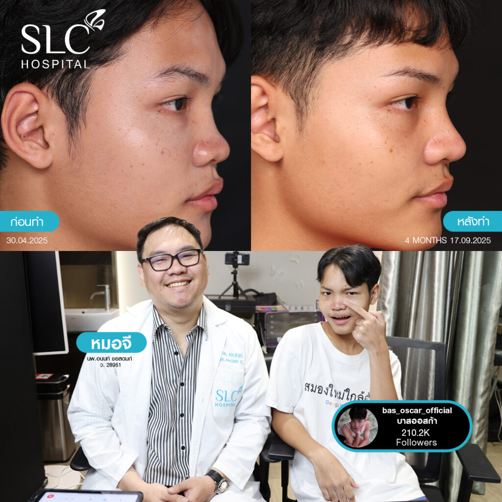 เสริมจมูก Semi Open หมอจี, SLC Hospital, เสริมจมูก Semi Open ดีไหม, เสริมจมูก Semi Open ที่ไหนดี