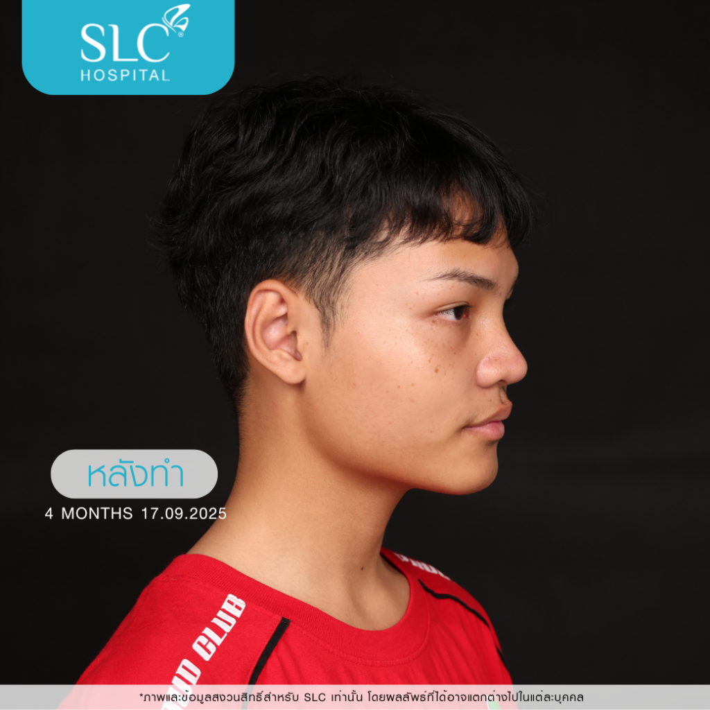 เสริมจมูก Semi Open หมอจี, SLC Hospital, เสริมจมูก Semi Open ดีไหม, เสริมจมูก Semi Open ที่ไหนดี