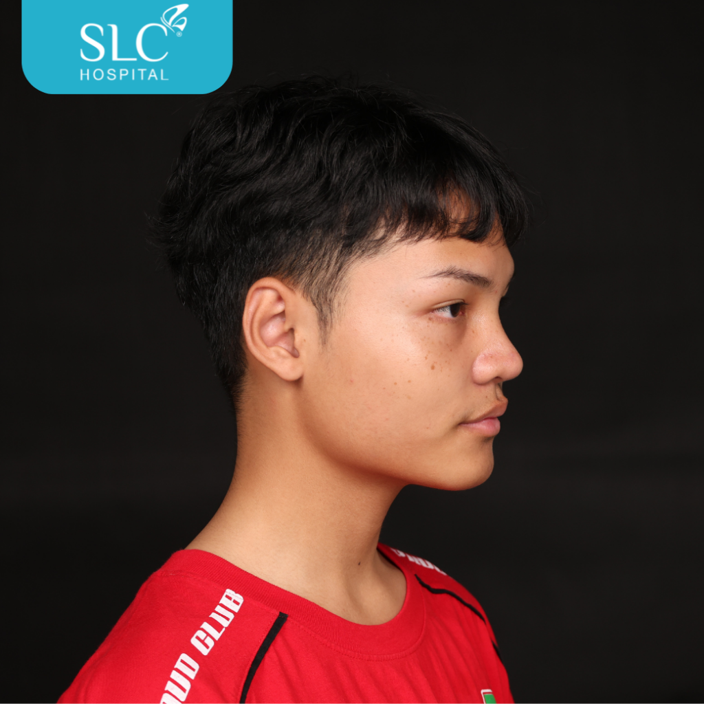 เสริมจมูก Semi Open หมอจี, SLC Hospital, เสริมจมูก Semi Open ดีไหม, เสริมจมูก Semi Open ที่ไหนดี