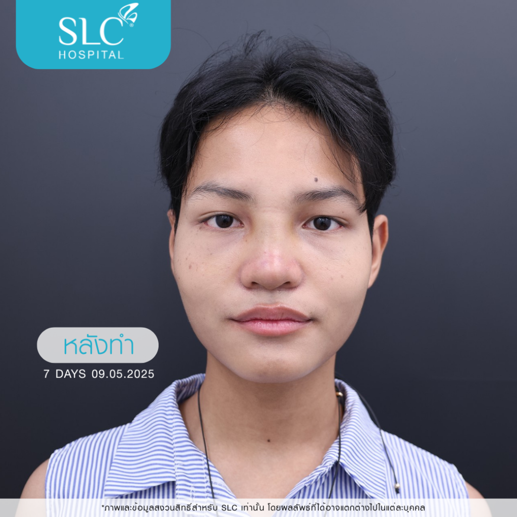 เสริมจมูก Semi Open หมอจี, SLC Hospital, เสริมจมูก Semi Open ดีไหม, เสริมจมูก Semi Open ที่ไหนดี
