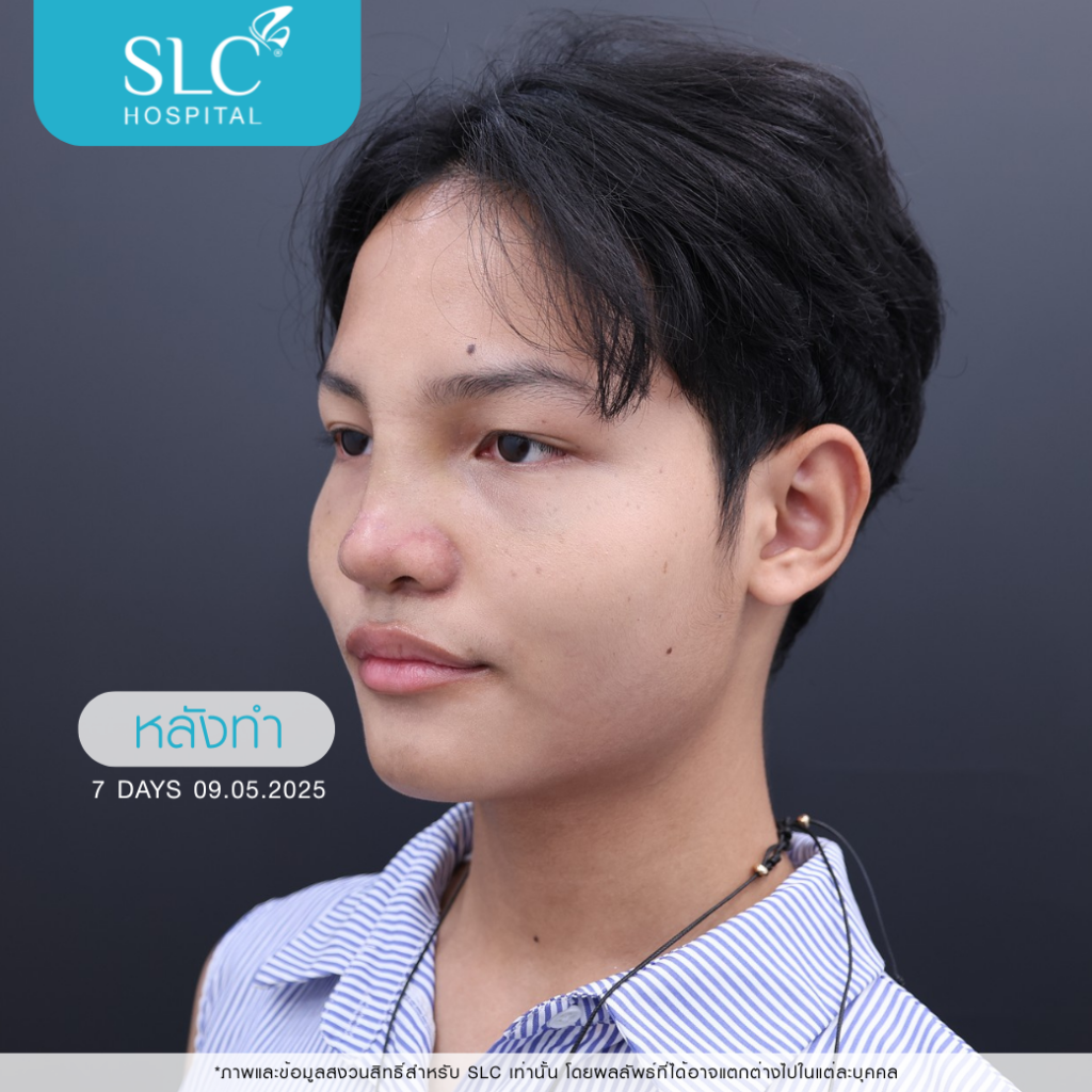 เสริมจมูก Semi Open หมอจี, SLC Hospital, เสริมจมูก Semi Open ดีไหม, เสริมจมูก Semi Open ที่ไหนดี