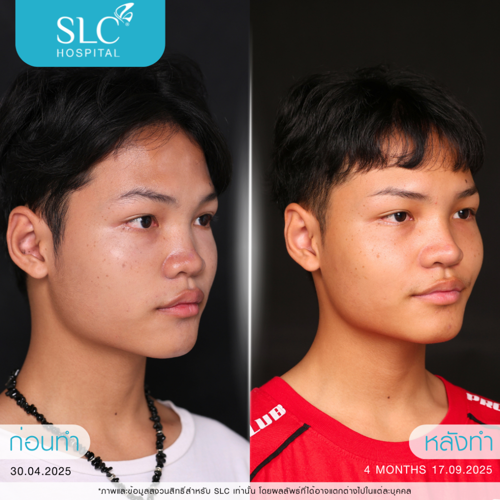 เสริมจมูก Semi Open หมอจี, SLC Hospital, เสริมจมูก Semi Open ดีไหม, เสริมจมูก Semi Open ที่ไหนดี