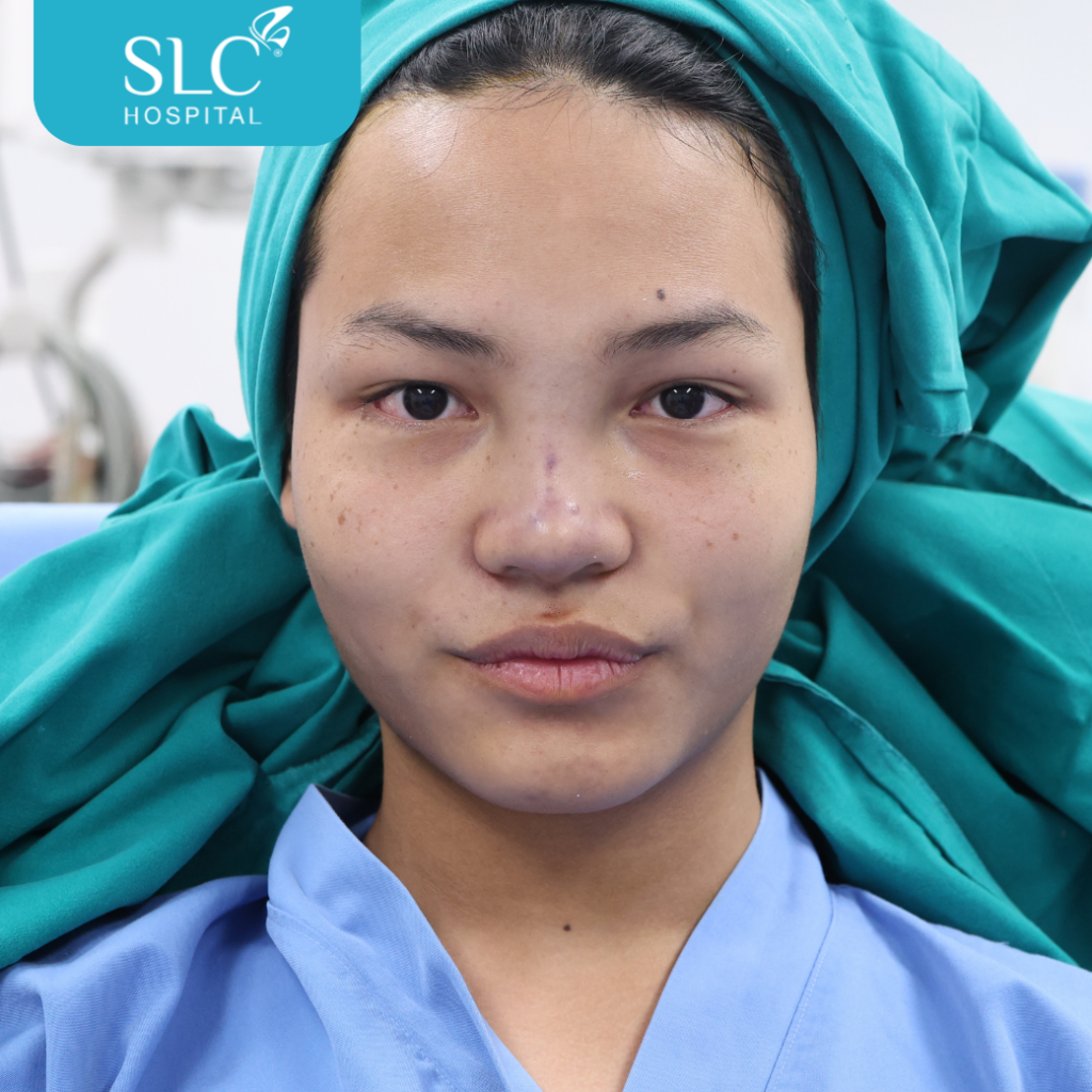 เสริมจมูก Semi Open หมอจี, SLC Hospital, เสริมจมูก Semi Open ดีไหม, เสริมจมูก Semi Open ที่ไหนดี