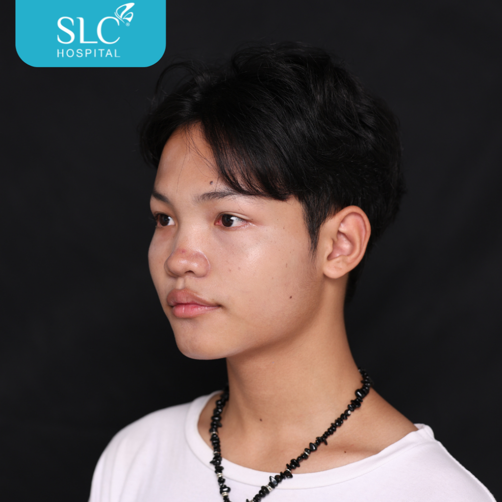 เสริมจมูก Semi Open หมอจี, SLC Hospital, เสริมจมูก Semi Open ดีไหม, เสริมจมูก Semi Open ที่ไหนดี