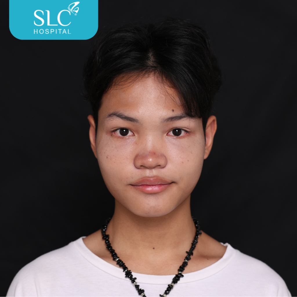 เสริมจมูก Semi Open หมอจี, SLC Hospital, เสริมจมูก Semi Open ดีไหม, เสริมจมูก Semi Open ที่ไหนดี