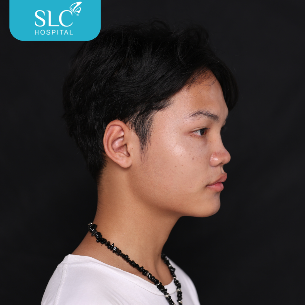 เสริมจมูก Semi Open หมอจี, SLC Hospital, เสริมจมูก Semi Open ดีไหม, เสริมจมูก Semi Open ที่ไหนดี