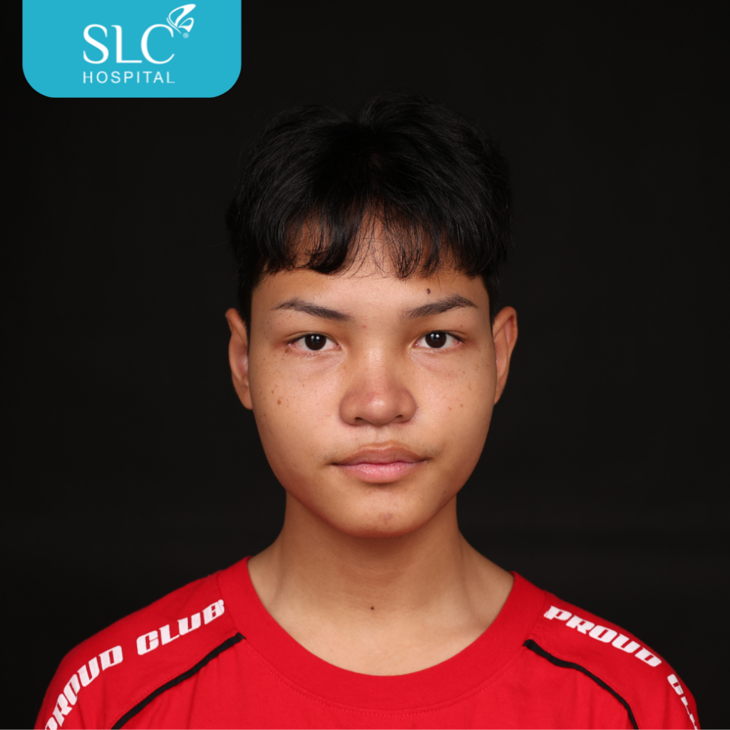 เสริมจมูก Semi Open หมอจี, SLC Hospital, เสริมจมูก Semi Open ดีไหม, เสริมจมูก Semi Open ที่ไหนดี