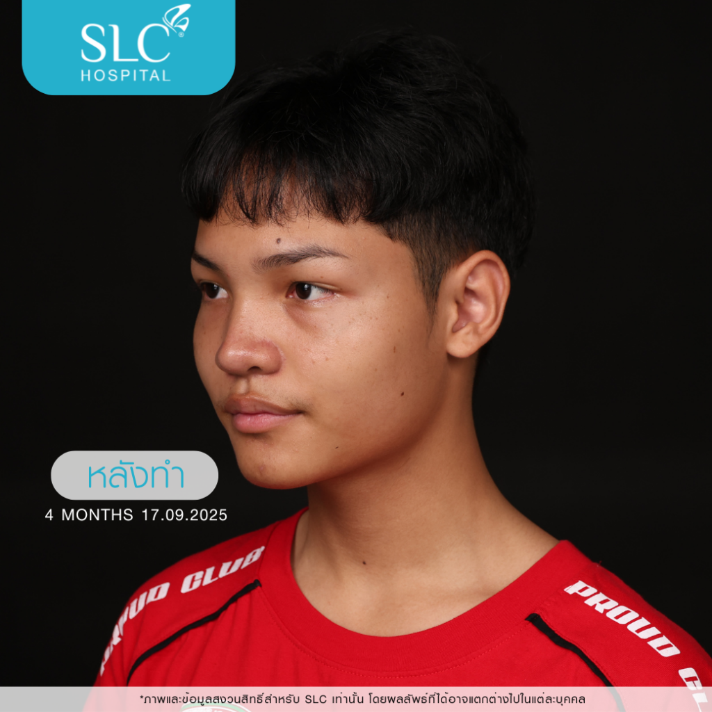 เสริมจมูก Semi Open, บาส ออสก้า