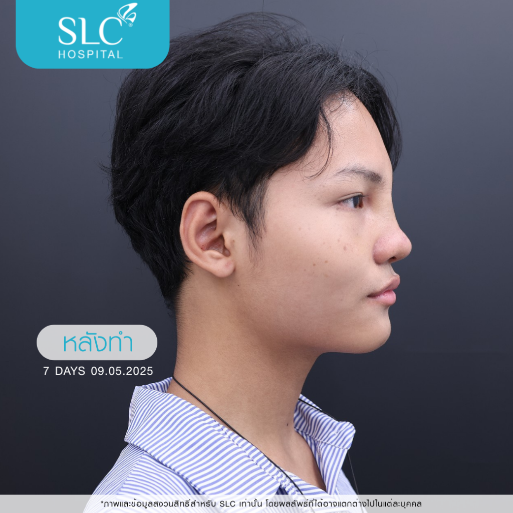 เสริมจมูก Semi Open, บาส ออสก้า