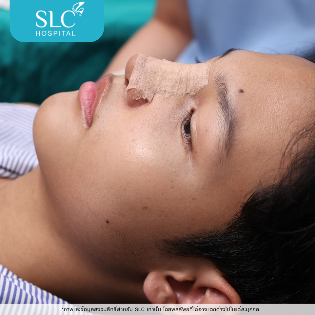 เสริมจมูก Semi Open, บาส ออสก้า