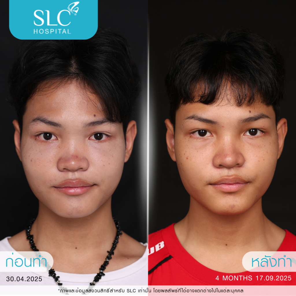 เสริมจมูก Semi Open, บาส ออสก้า