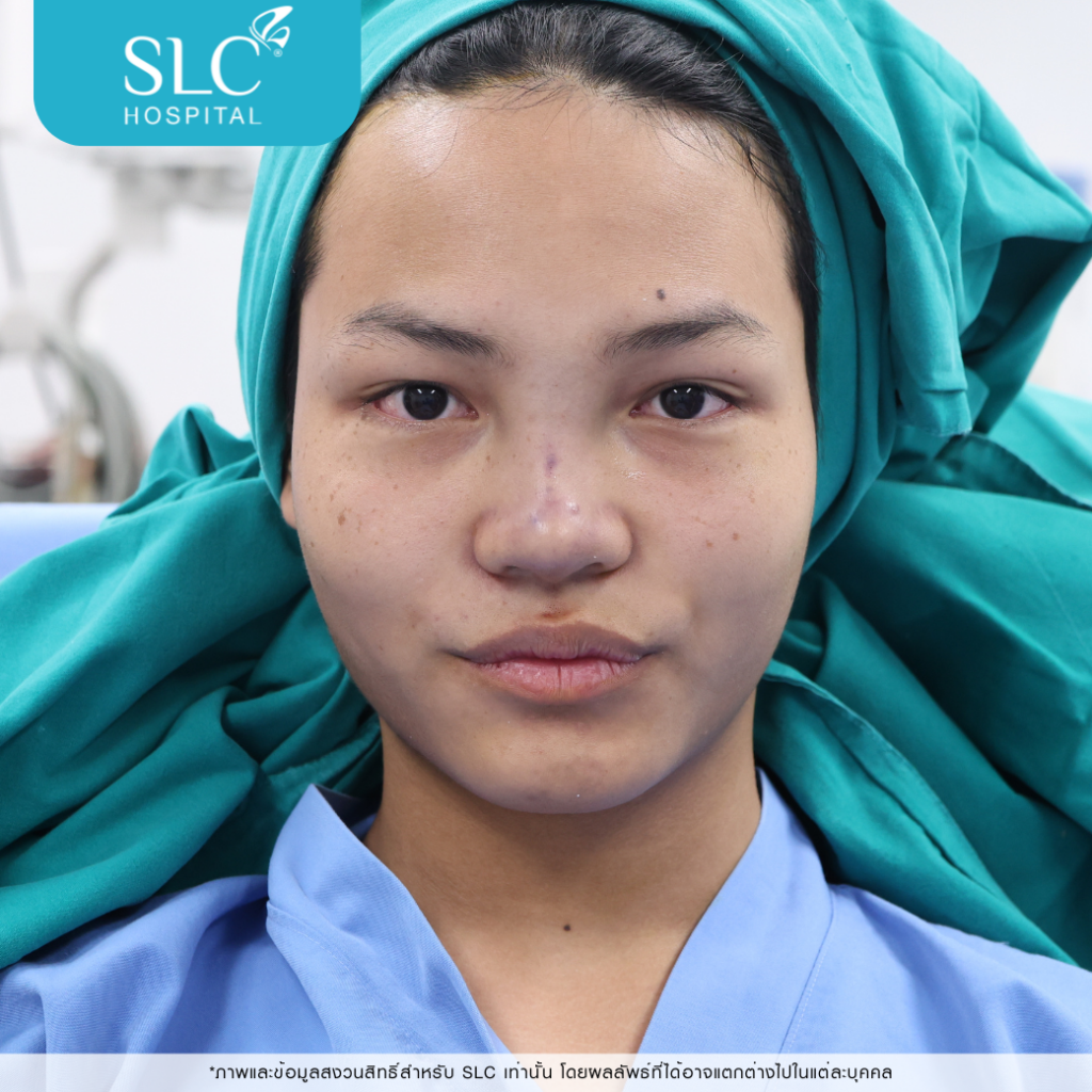 เสริมจมูก Semi Open, บาส ออสก้า