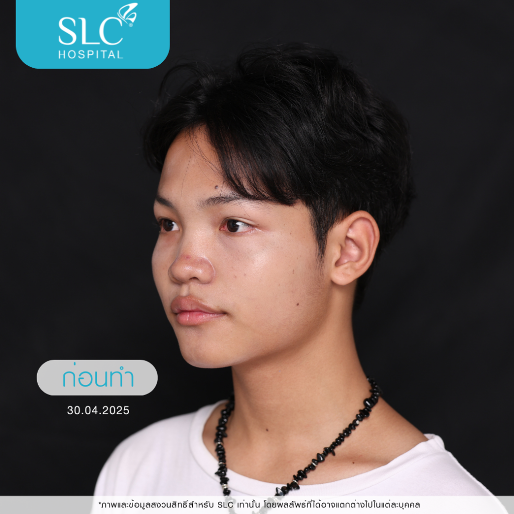 เสริมจมูก Semi Open, บาส ออสก้า