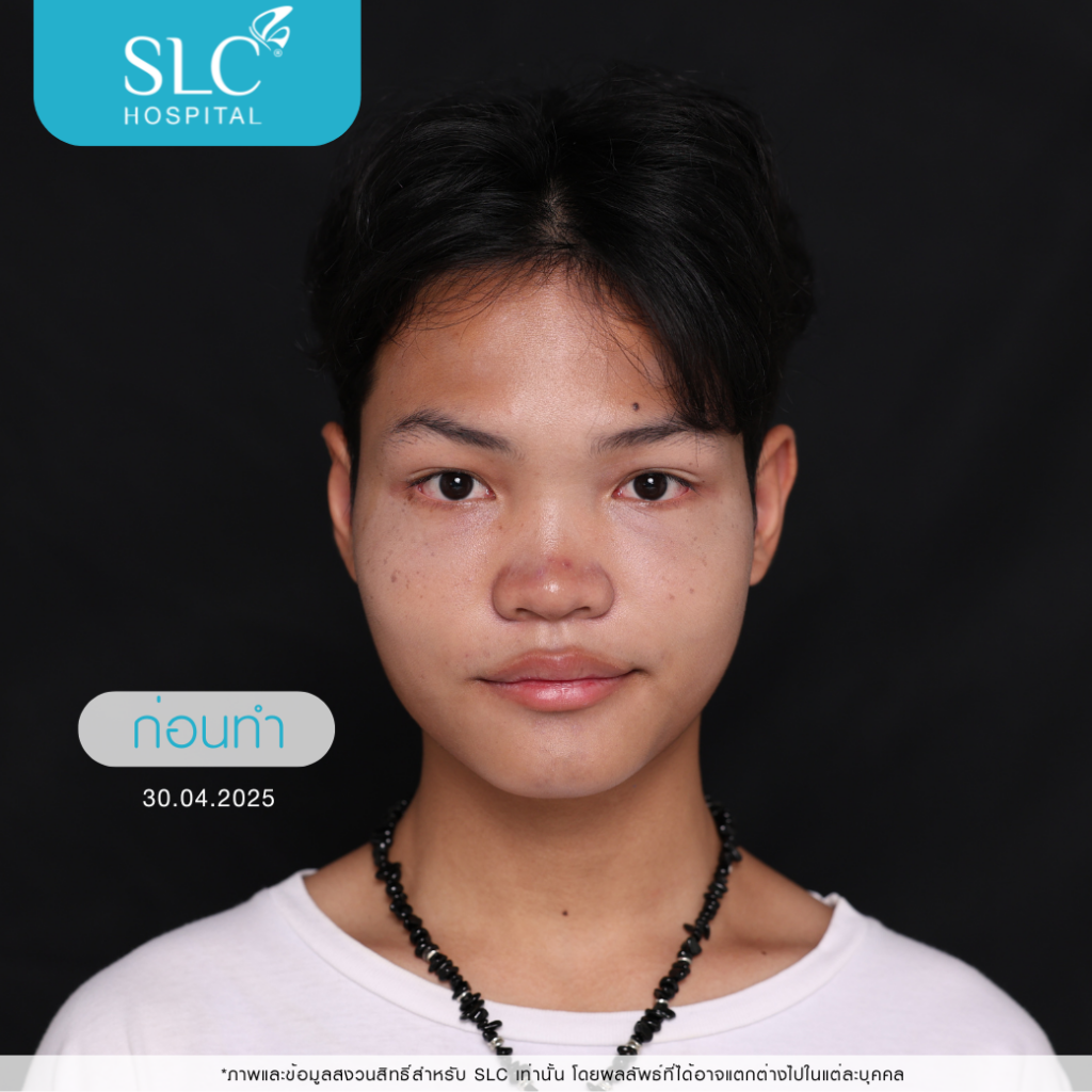 เสริมจมูก Semi Open, บาส ออสก้า