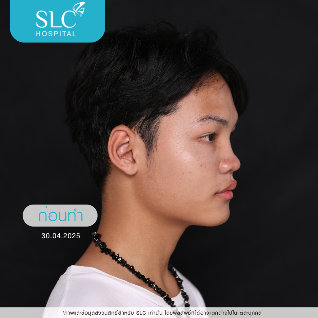 เสริมจมูก Semi Open, บาส ออสก้า