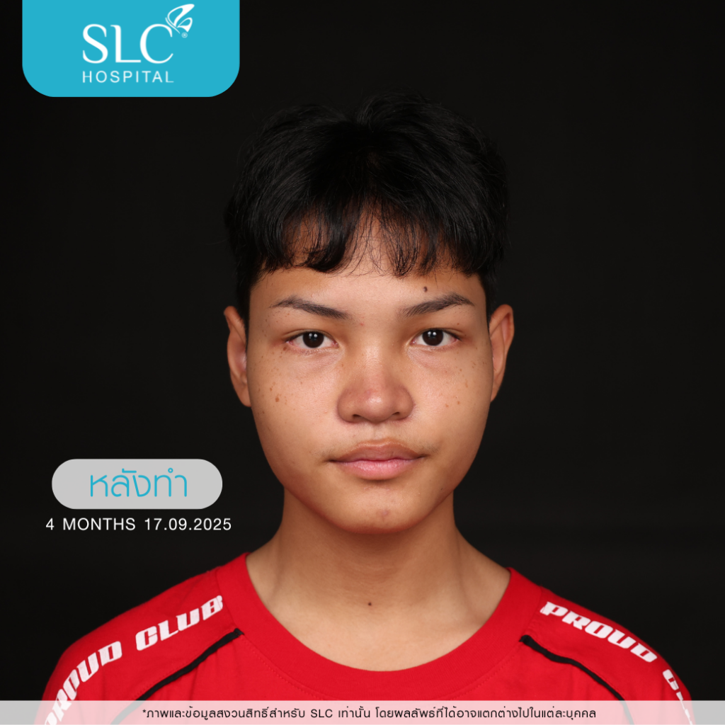 เสริมจมูก Semi Open, บาส ออสก้า