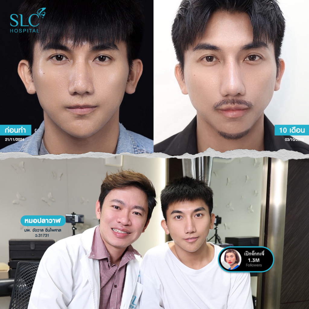 เสริมจมูก Open, SLC Hospital, เป๊กจั๊กกะจี้, เสริมจมูก Open ที่ไหนดี