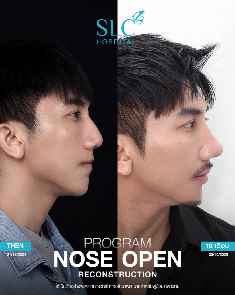 เสริมจมูก Open, SLC Hospital, เป๊กจั๊กกะจี้, เสริมจมูก Open ที่ไหนดี