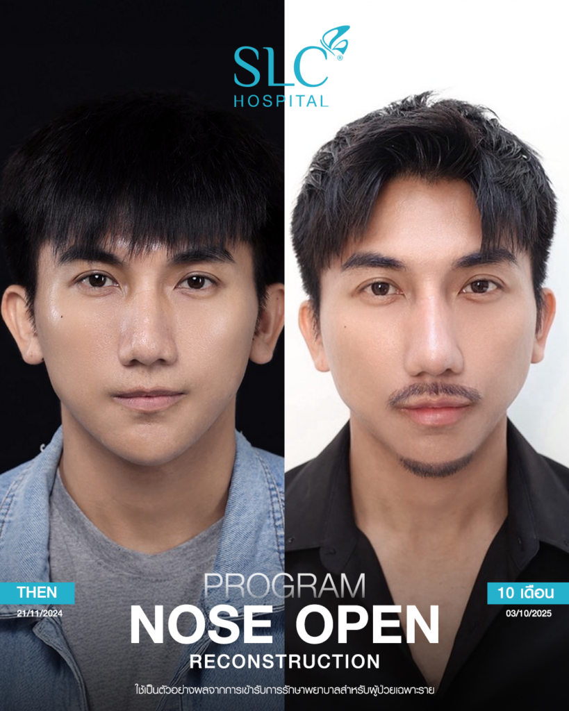 เสริมจมูก Open, SLC Hospital, เป๊กจั๊กกะจี้, เสริมจมูก Open ที่ไหนดี