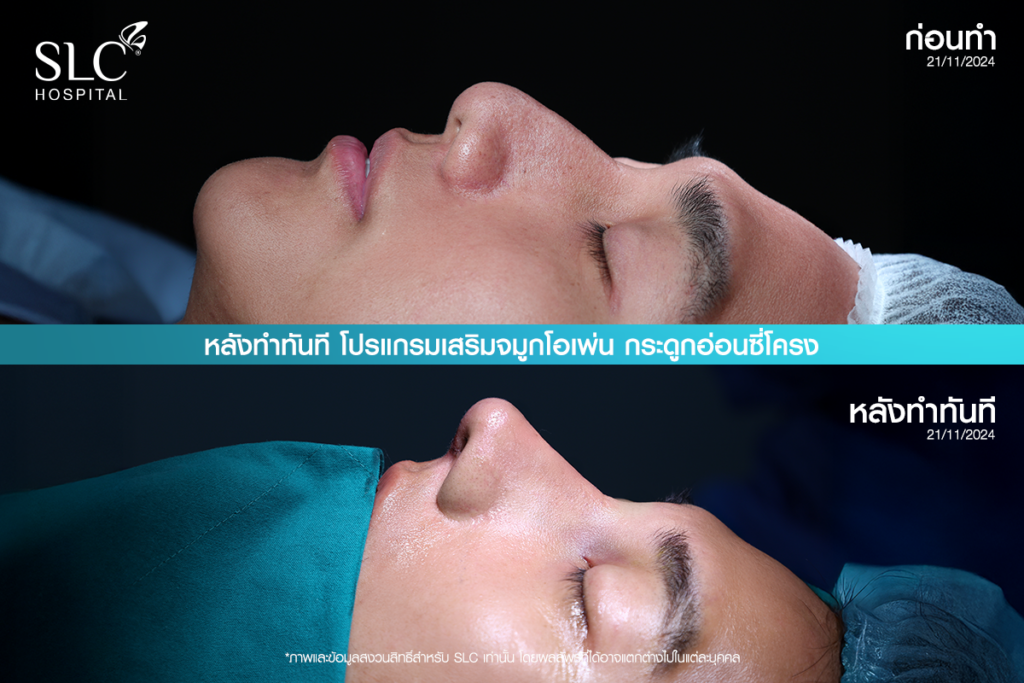 เสริมจมูก Open, SLC Hospital, เป๊กจั๊กกะจี้, เสริมจมูก Open ที่ไหนดี
