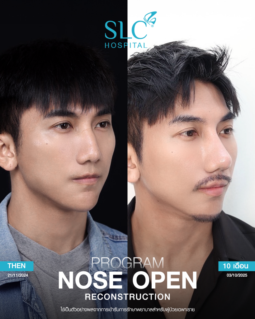เสริมจมูก Open, SLC Hospital, เป๊กจั๊กกะจี้, เสริมจมูก Open ที่ไหนดี