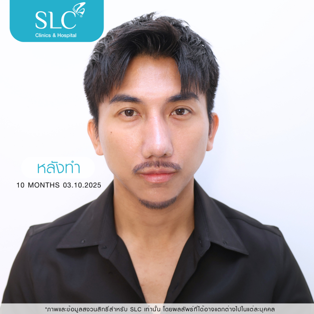 เสริมจมูก Open, SLC Hospital, เป๊กจั๊กกะจี้, เสริมจมูก Open ที่ไหนดี