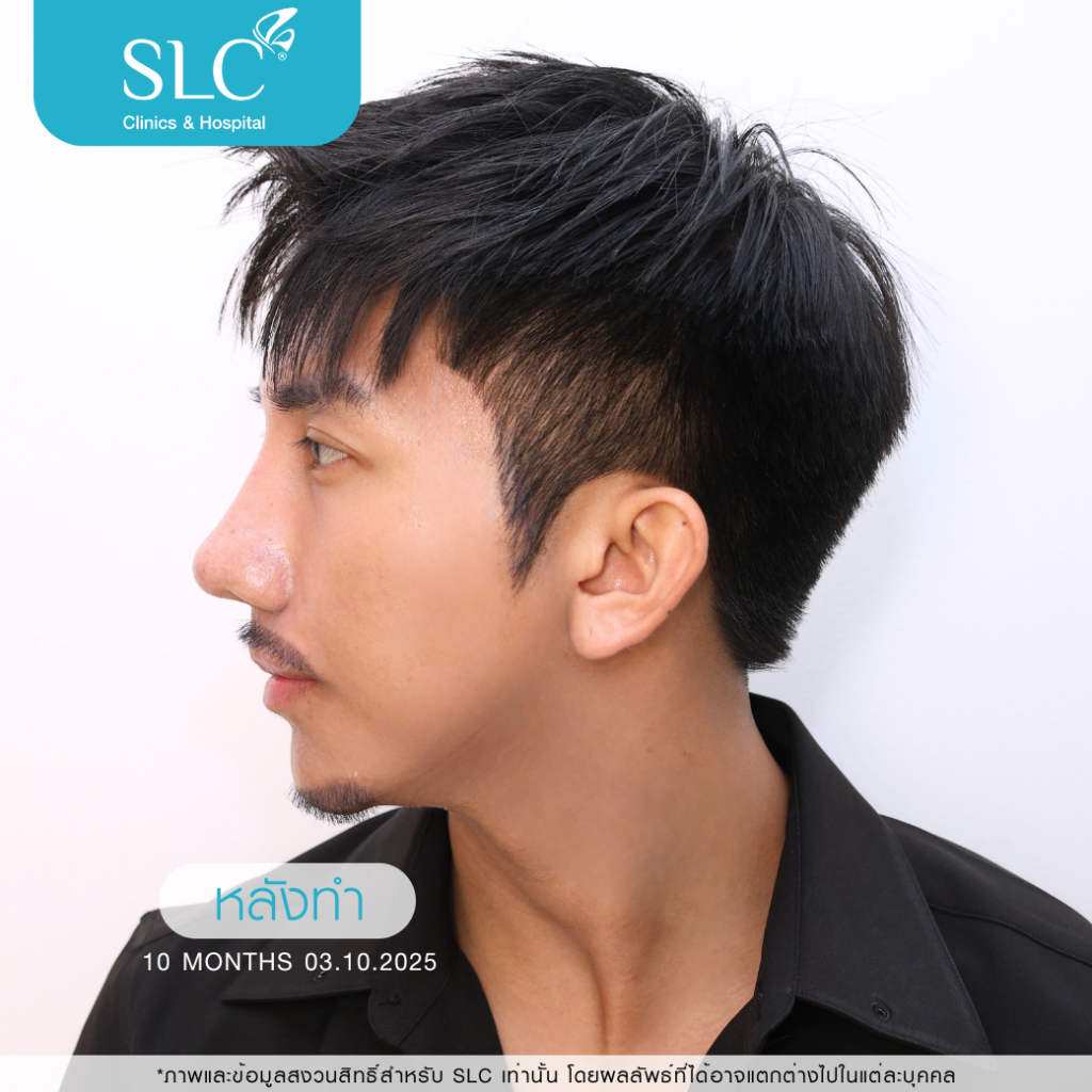 เสริมจมูก Open, SLC Hospital, เป๊กจั๊กกะจี้, เสริมจมูก Open ที่ไหนดี