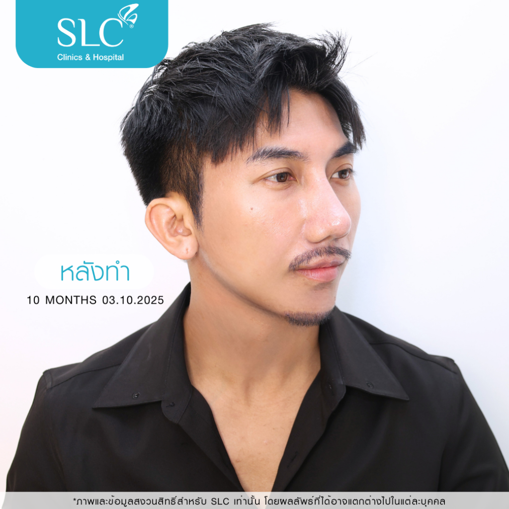 เสริมจมูก Open, SLC Hospital, เป๊กจั๊กกะจี้, เสริมจมูก Open ที่ไหนดี