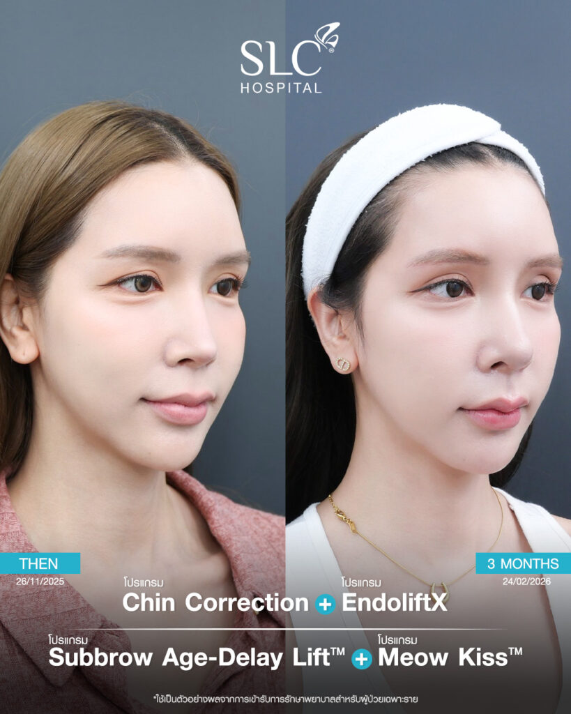 meowkiss-cat-lip-surgery-review