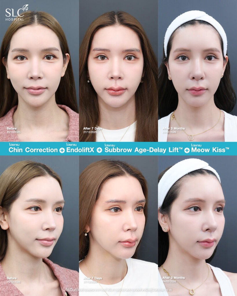 meowkiss-cat-lip-surgery-review